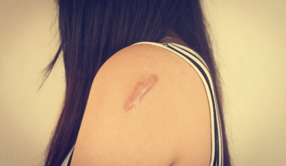 Photo d'une femme avec un Préjudice esthétique permanent (cicatrice)